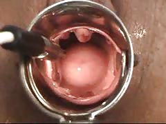 gynecological examining